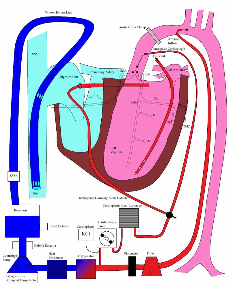 Image of Cardiopulmonary bypass (112K)  Please wait for it to load.  Thank you.  - Art Wallace MD PhD